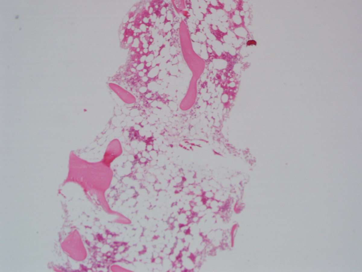 Bone marrow Biopsy March 2005
